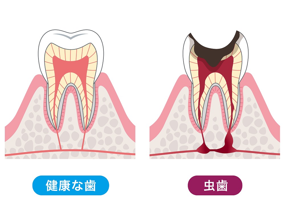 むし歯治療について