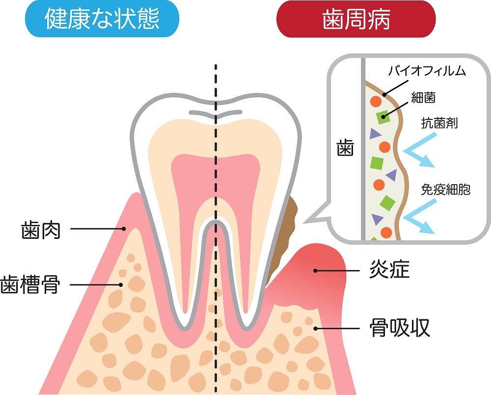 歯周病は早期発見が大切